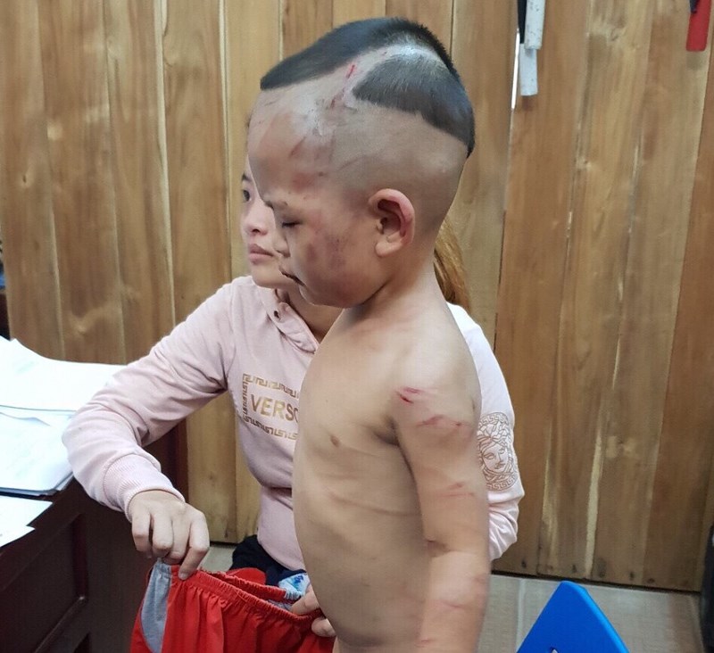 bé trai 3 tuổi bị cha dượng bạo hành dã man